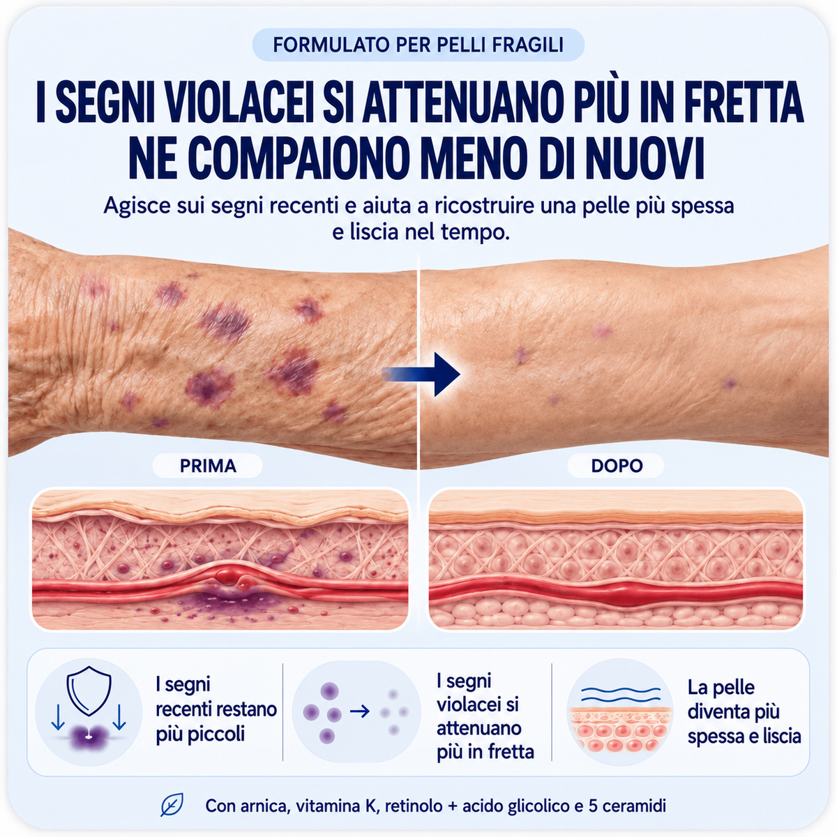 Crema anti-lividi per pelli fragili
