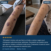 Crema anti-lividi per pelli fragili