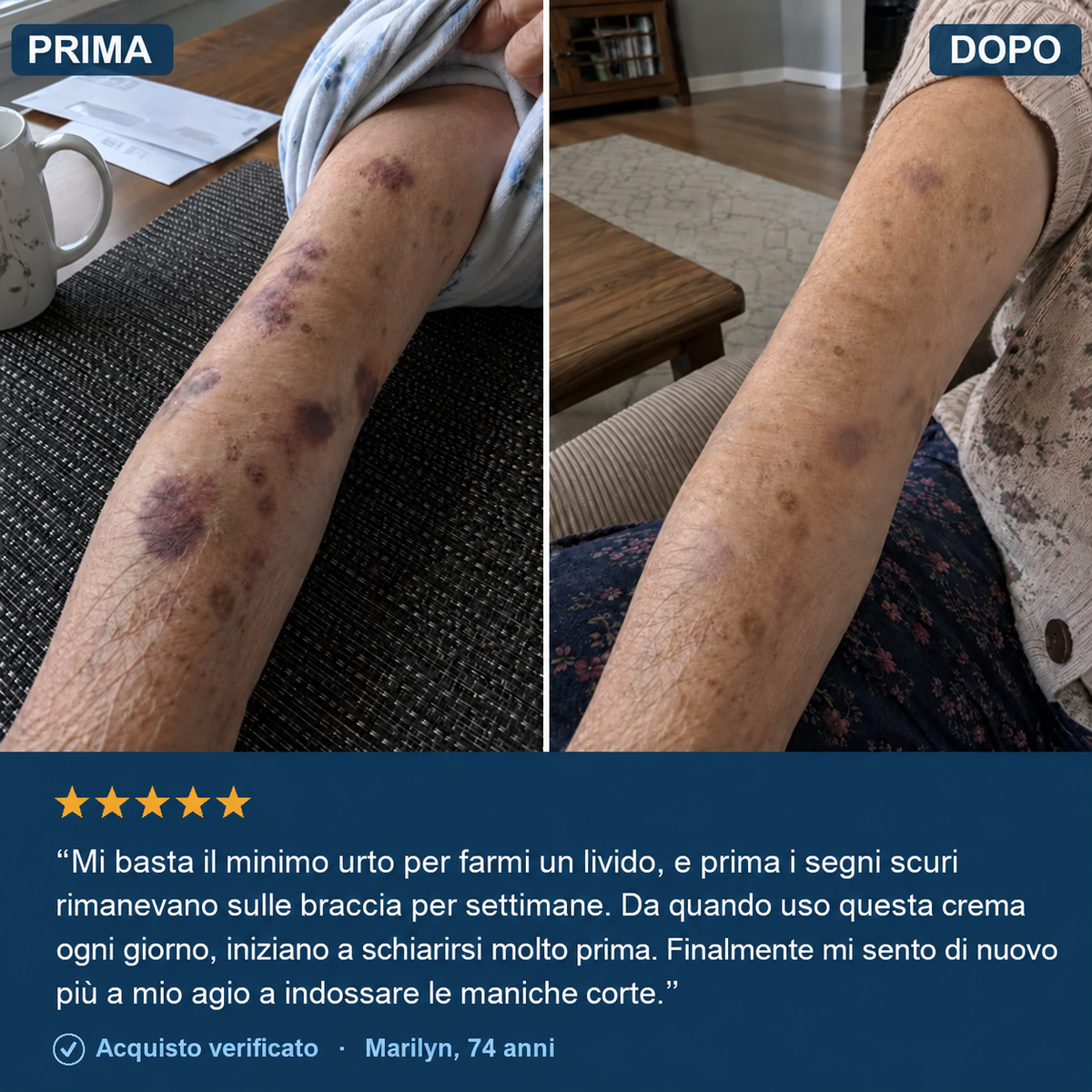 Crema anti-lividi per pelli fragili