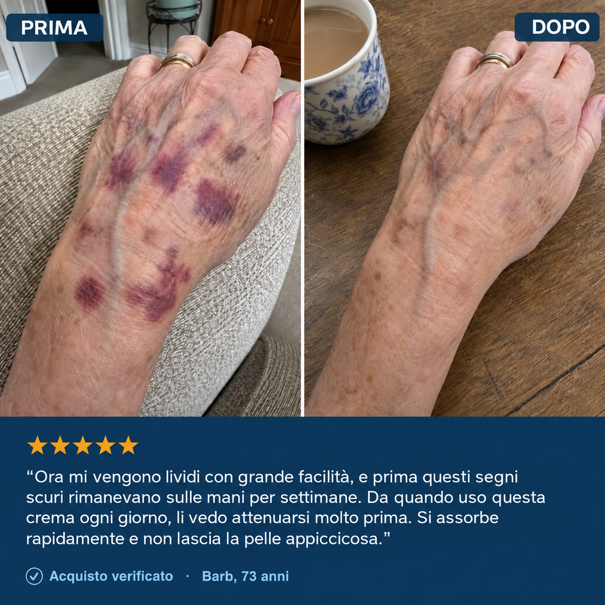 Crema anti-lividi per pelli fragili